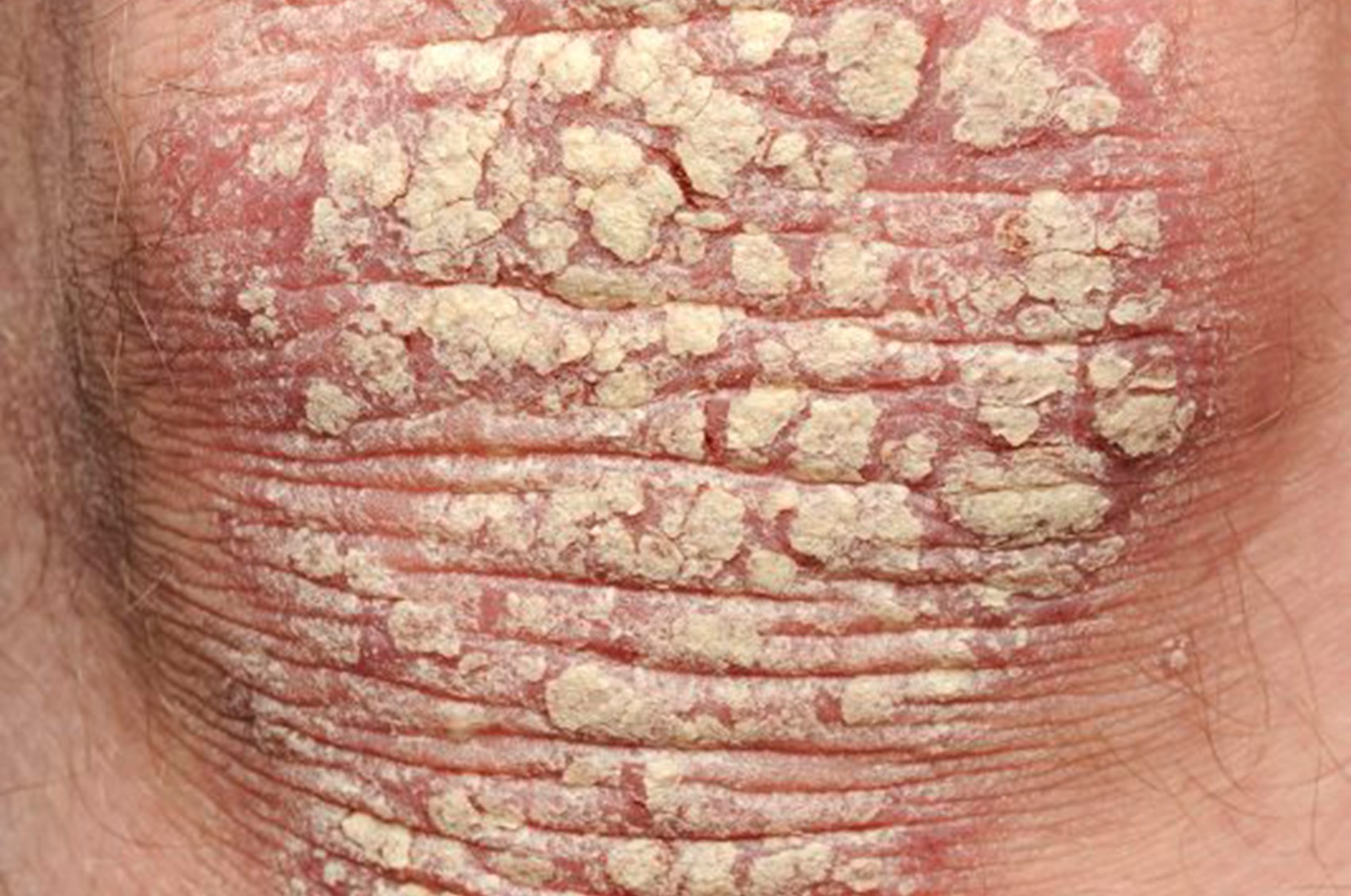 263009 silvery white scaling.jpg