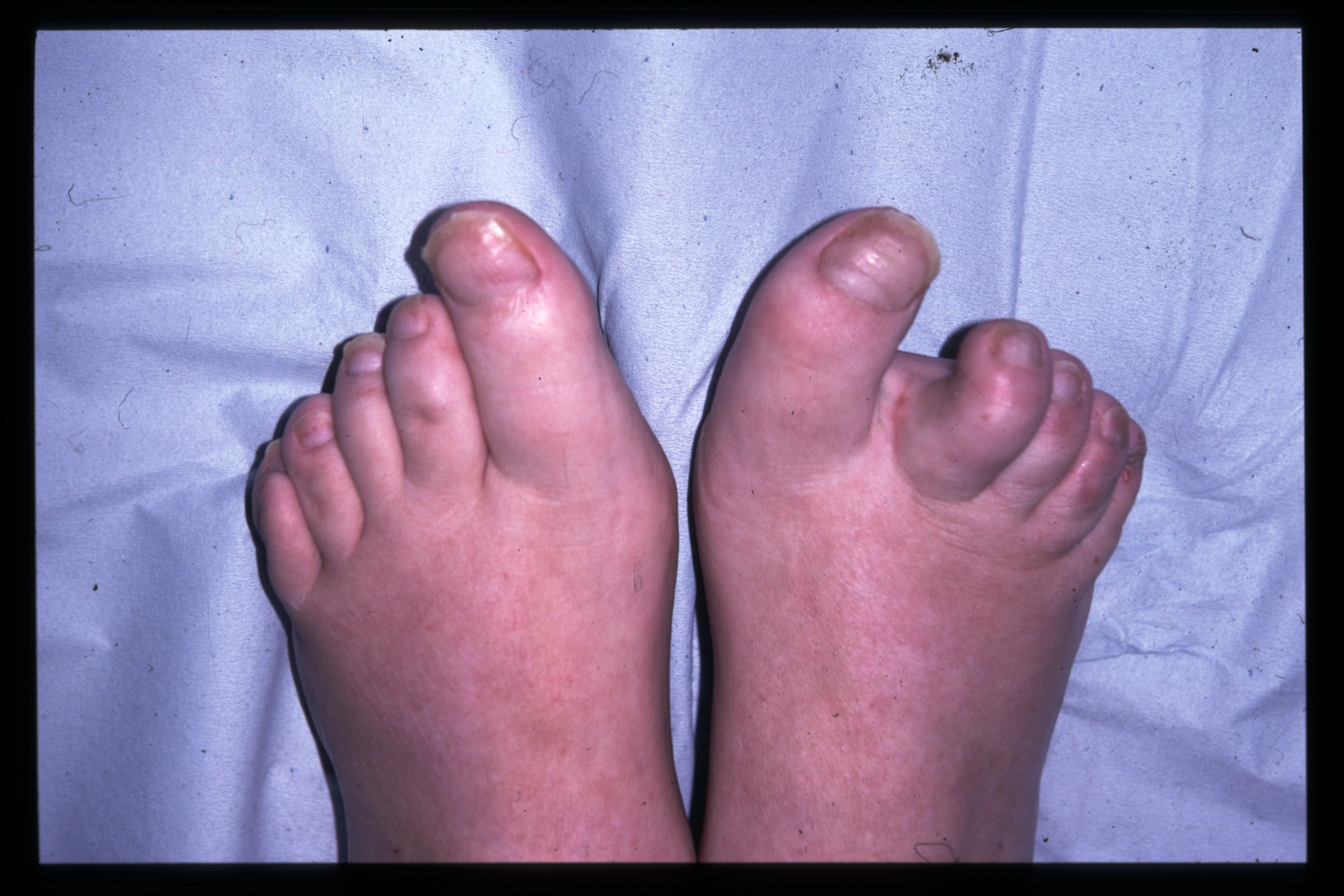 How to Get Rid of Hard Skin on Feet | Exfoliating | NIVEA