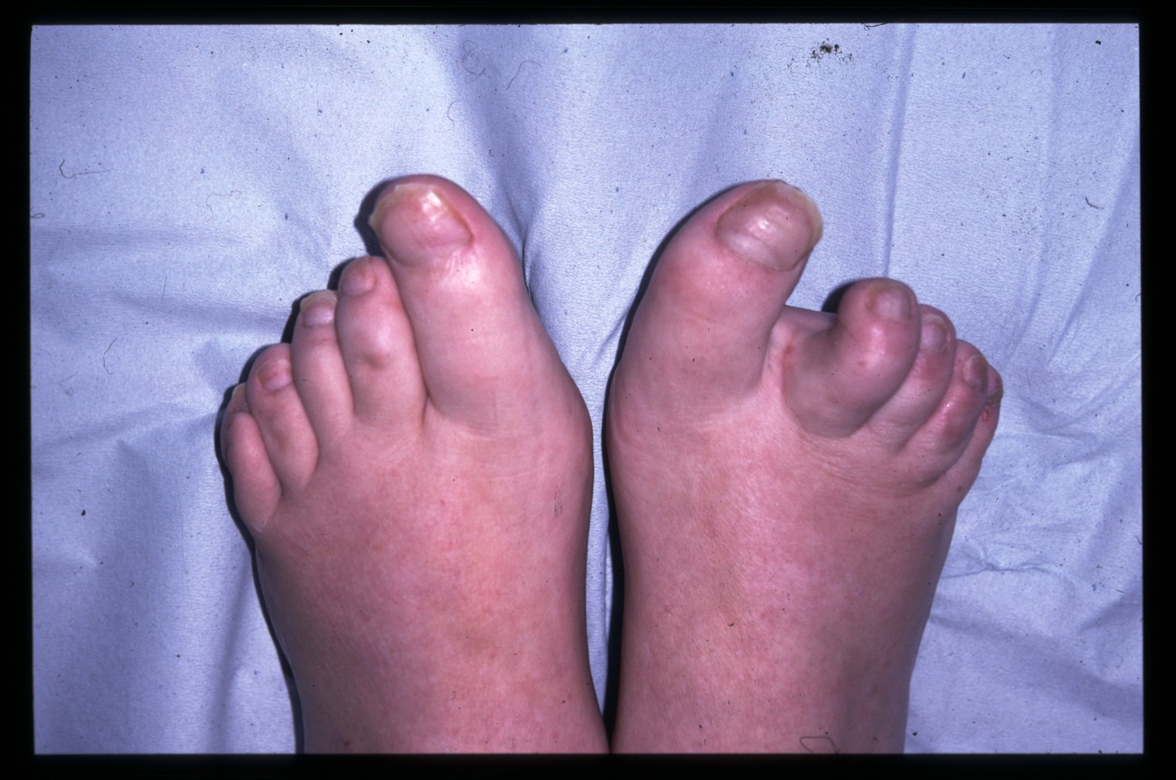 Thickening of skin on feet