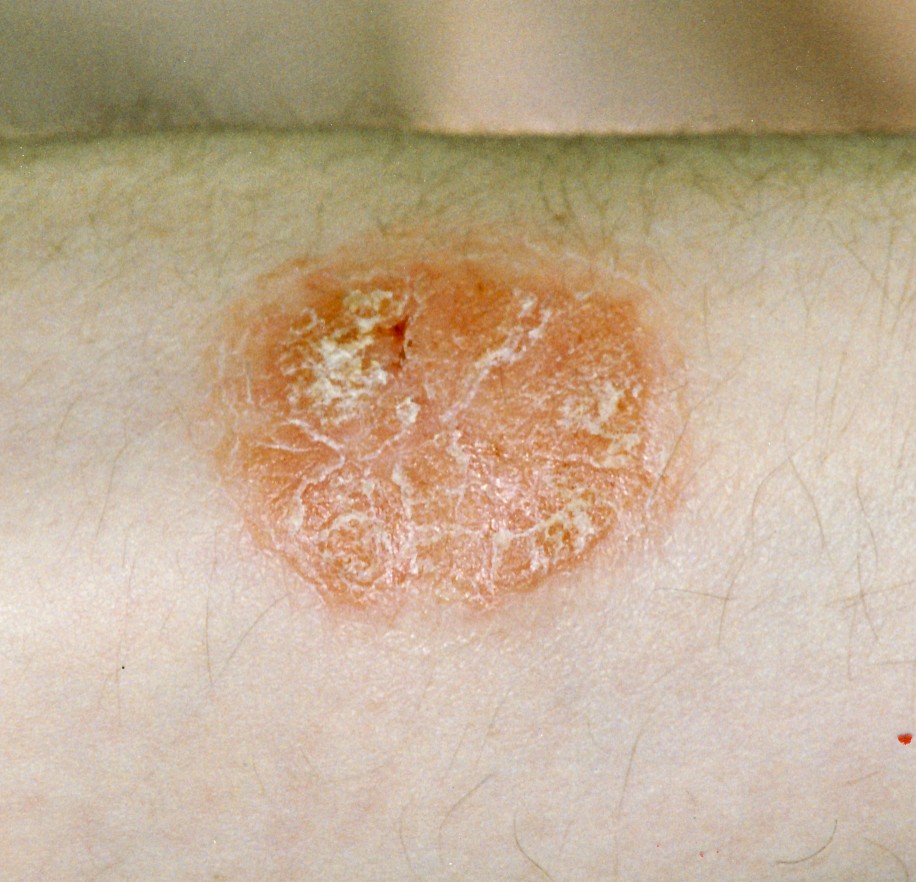 WHAT IS PSORIASIS AND HOW CAN I TREAT IT? - Pevonia