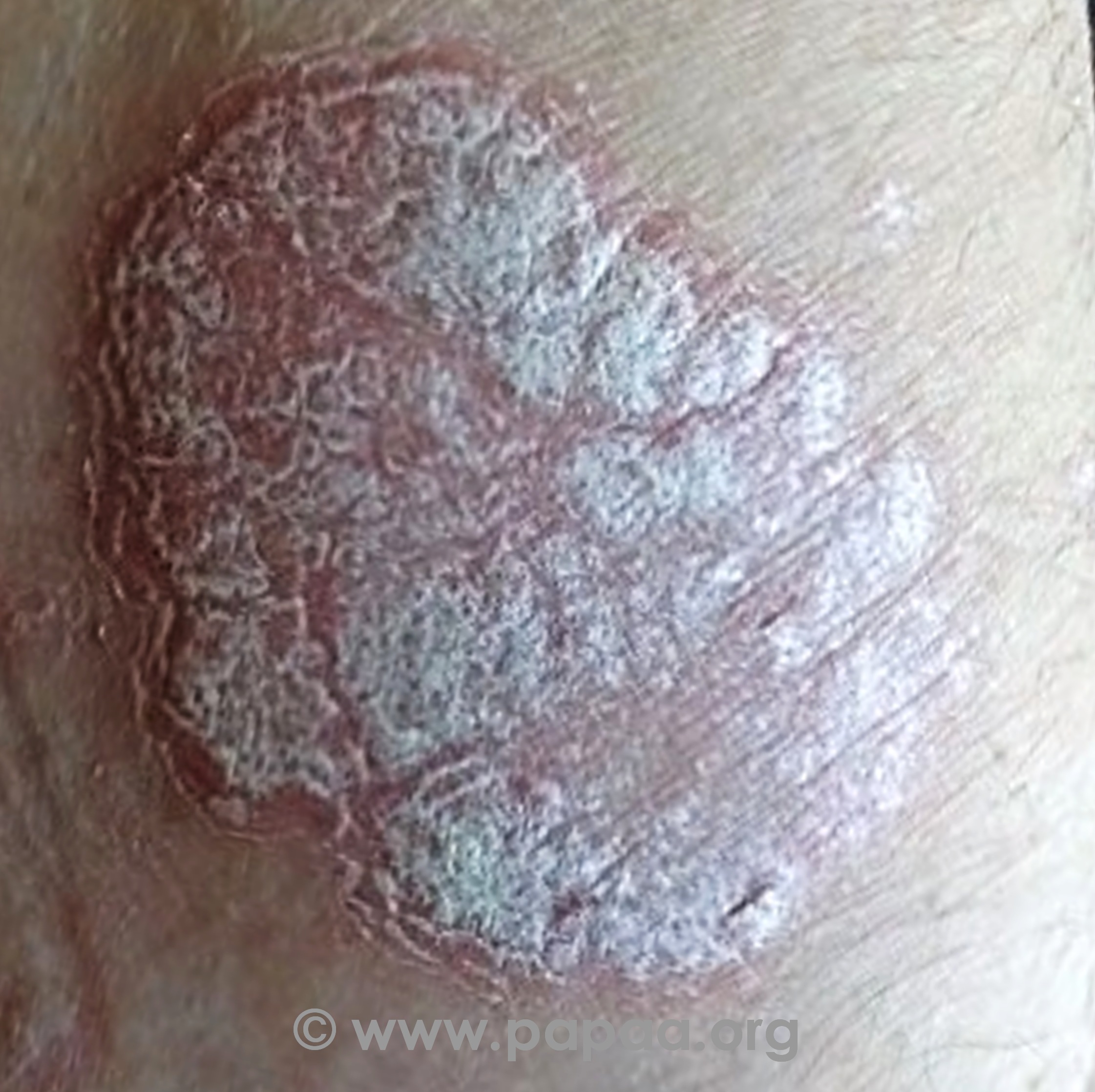Types of psoriasis, who gets it, how they are affected and what to expect.