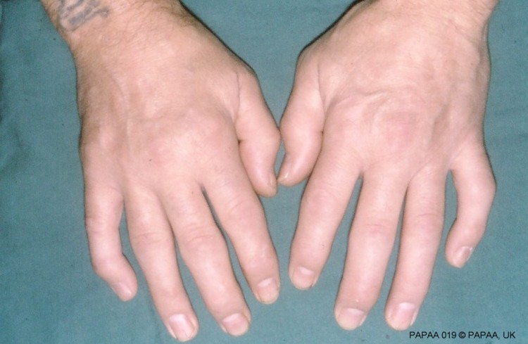 arthritis hands early signs